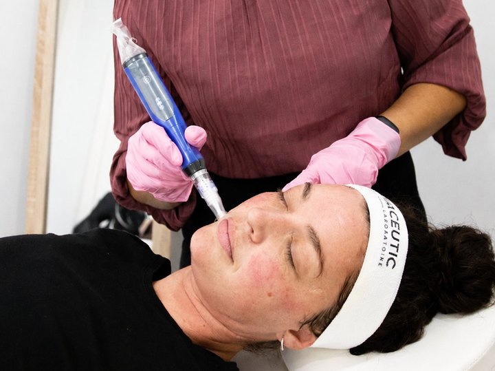SkinPen skin needling at NEA